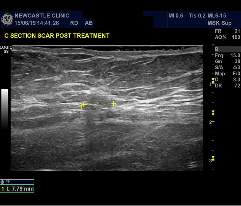 new research on scars